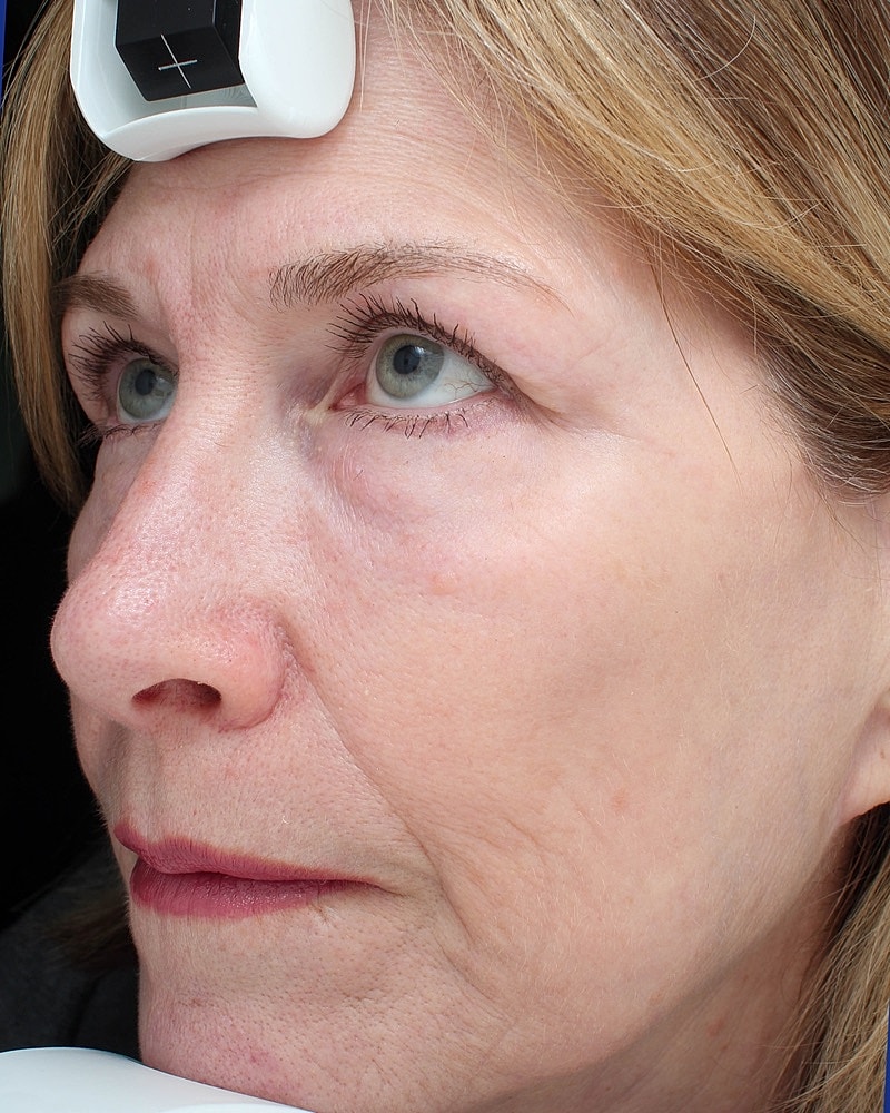 Skin Resurfacing Before & After