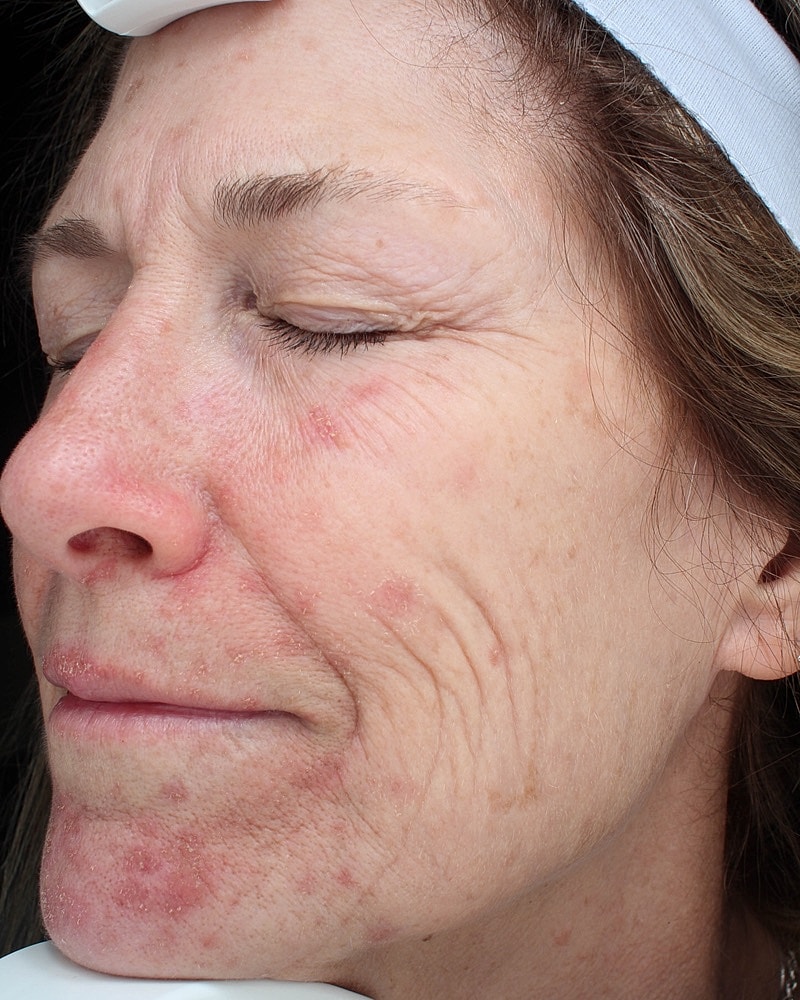 Skin Resurfacing Before & After