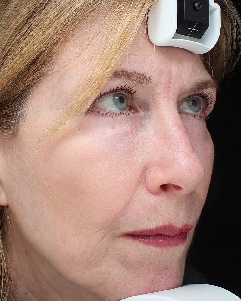 Skin Resurfacing Before & After