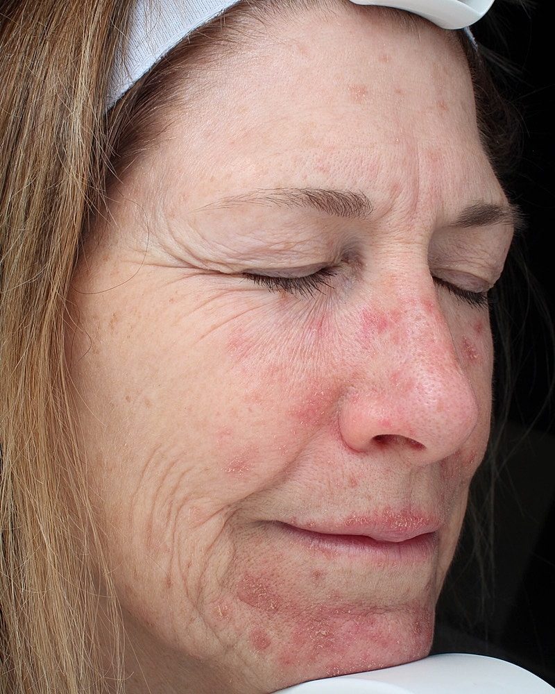 Skin Resurfacing Before & After