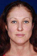Skin Resurfacing Before & After