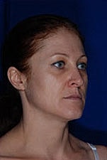 Skin Resurfacing Before & After