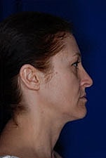 Skin Resurfacing Before & After