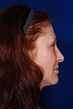 Skin Resurfacing Before & After