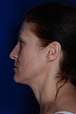 Skin Resurfacing Before & After