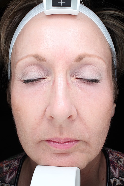 Skin Resurfacing Before & After