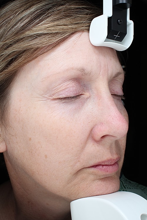 Skin Resurfacing Before & After