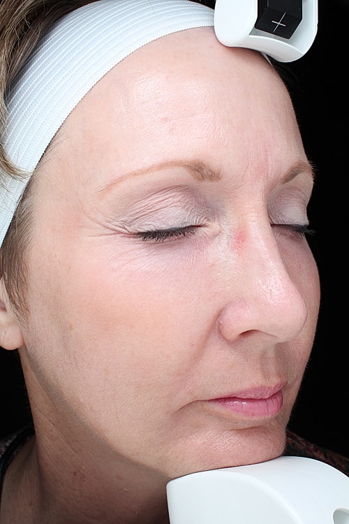 Skin Resurfacing Before & After