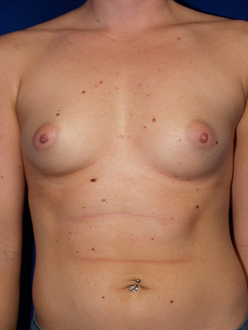 Breast Augmentation Before & After