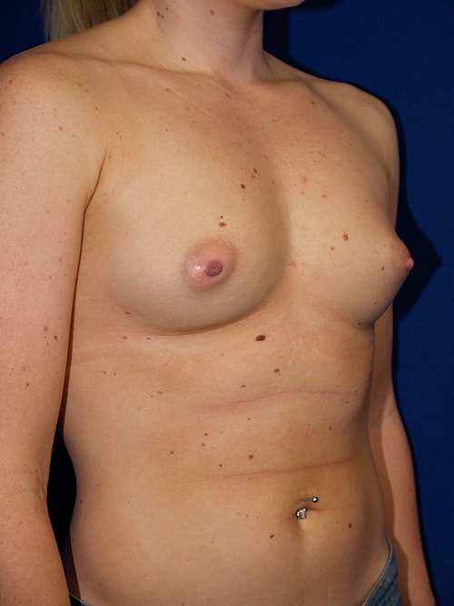 Breast Augmentation Before & After