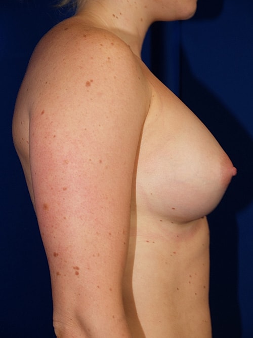 Breast Augmentation Before & After