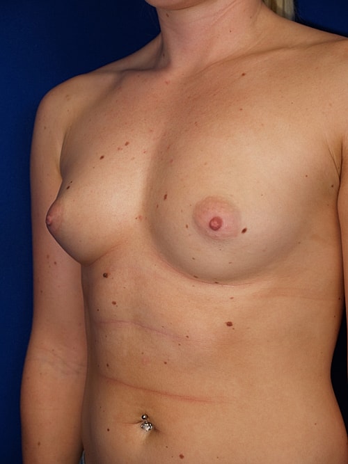 Breast Augmentation Before & After