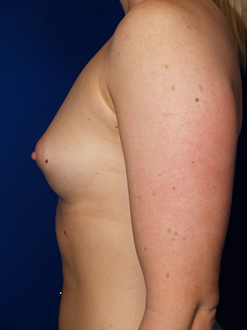 Breast Augmentation Before & After