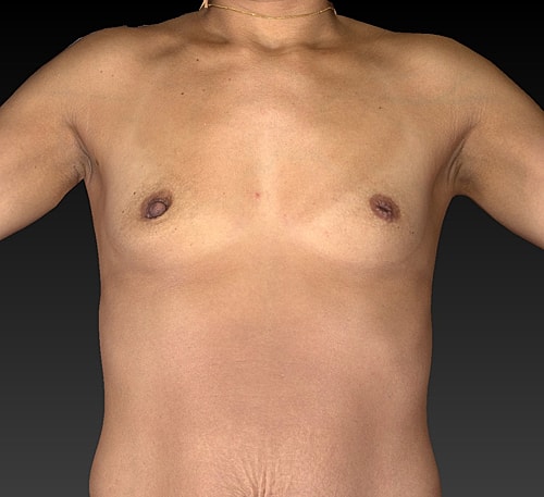 Breast Augmentation Before & After