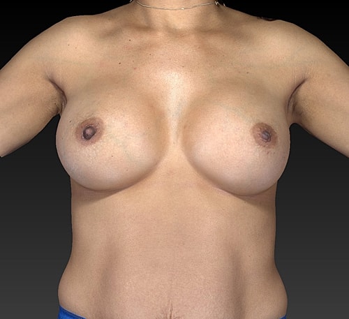 Breast Augmentation Before & After