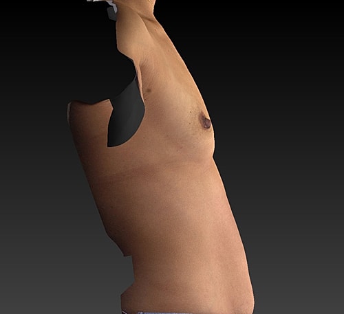 Breast Augmentation Before & After