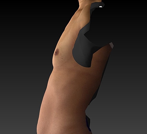 Breast Augmentation Before & After