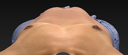 Breast Augmentation Before & After