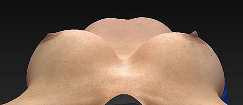 Breast Augmentation Before & After