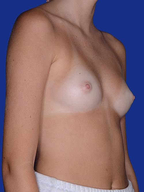 Breast Augmentation Before & After