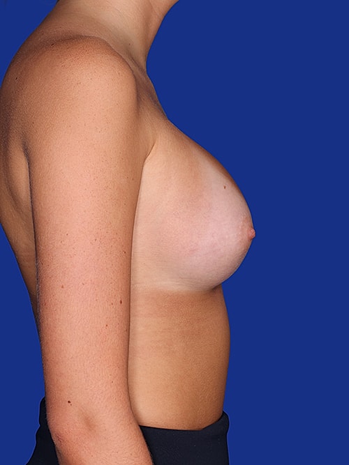 Breast Augmentation Before & After