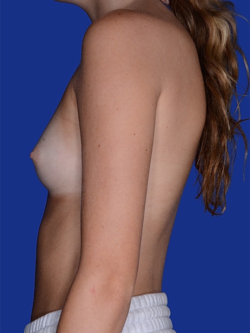 Breast Augmentation Before & After