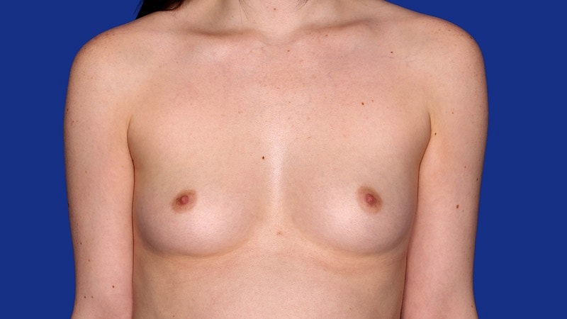 Breast Augmentation Before & After