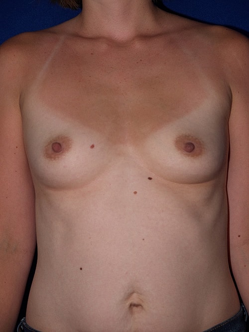 Breast Augmentation Before & After