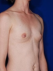 Breast Augmentation Before & After