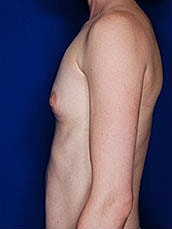 Breast Augmentation Before & After