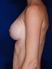 Breast Augmentation Before & After