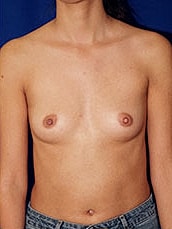 Breast Augmentation Before & After