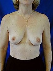 Breast Augmentation Before & After