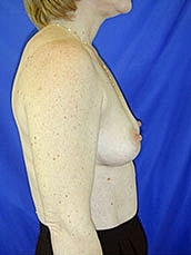 Breast Augmentation Before & After