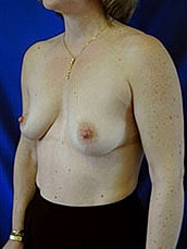 Breast Augmentation Before & After