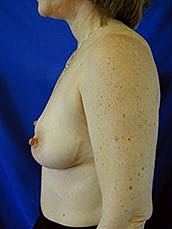 Breast Augmentation Before & After