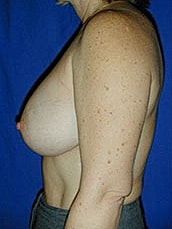 Breast Augmentation Before & After