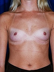 Breast Augmentation Before & After