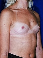 Breast Augmentation Before & After