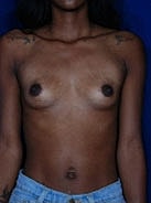 Breast Augmentation Before & After