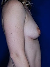 Breast Augmentation Before & After