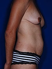 Breast Augmentation Before & After