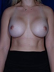Breast Augmentation Before & After