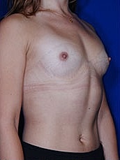Breast Augmentation Before & After