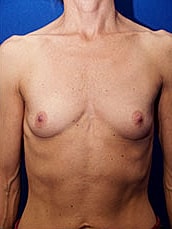 Breast Augmentation Before & After