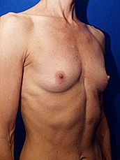 Breast Augmentation Before & After