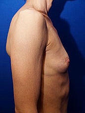 Breast Augmentation Before & After