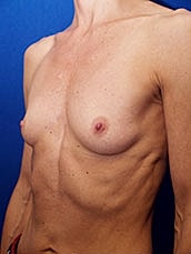 Breast Augmentation Before & After