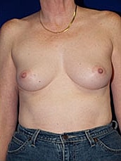 Breast Augmentation Before & After