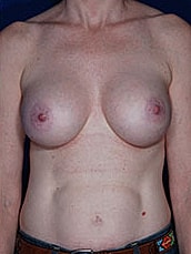 Breast Augmentation Before & After